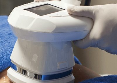 3D Lipo (Fat Freezing) Clinic Leeds